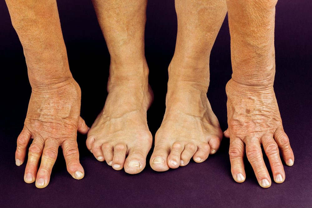 Артрит мелких суставов рук и стопы - диагностика, лечение | Med & Care