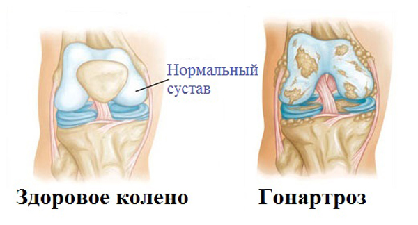 Заболевания по направлению Гонартроз коленного сустава